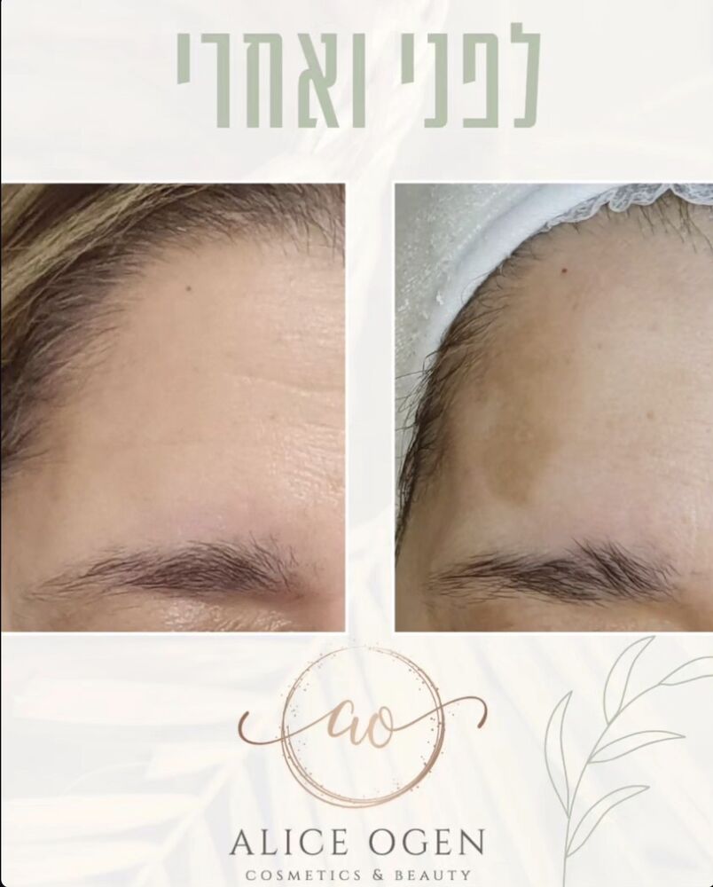 תוצאת טיפול לפני ואחרי בקליניקה של אליס עוגן, תמונה 6