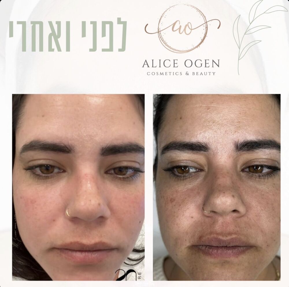 תוצאת טיפול לפני ואחרי בקליניקה של אליס עוגן, תמונה 7