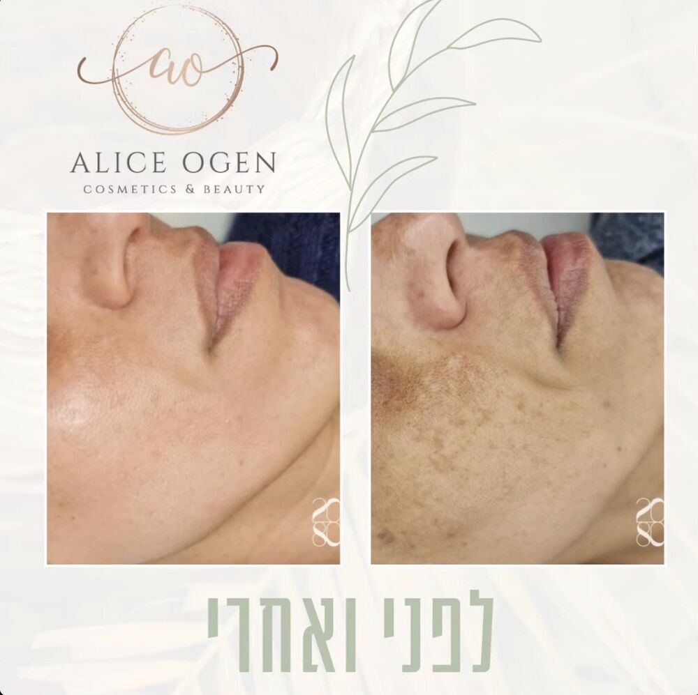 תוצאת טיפול לפני ואחרי בקליניקה של אליס עוגן, תמונה 5